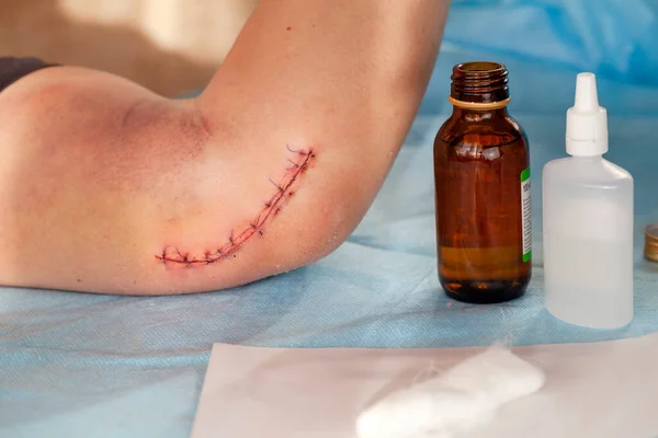 Surgical suture close-up, elbow neuropathy, wound treatment after surgery
