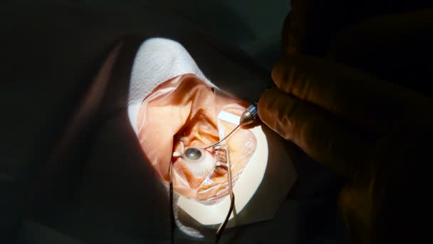 Oftalmologi. Ögonoperationer. Läkare sprutar en spruta injektion in i öppna ögat. På nära håll — Stockvideo