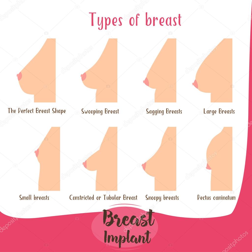 Types Breast Breast Shapes: стоковая векторная графика (без лицензионных  платежей), 2189658841