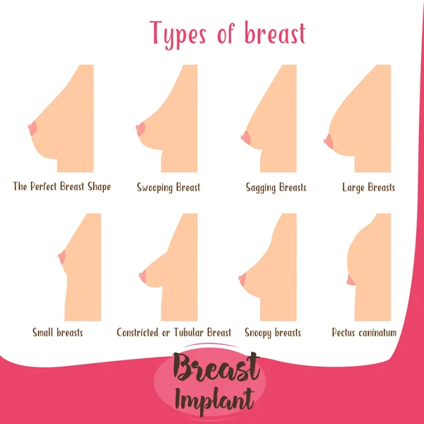 De olika formerna av bröst uppsättning . — Stock vektor