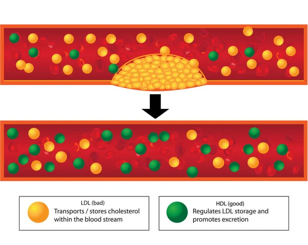 Papel de los lípidos buenos y malos y niveles de placa aterosclerótica en los vasos sanguíneos — Vector de stock