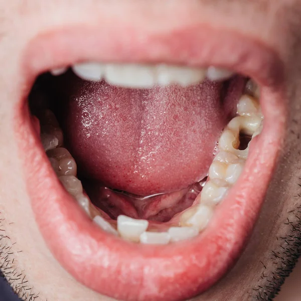 Gran Agujero Diente Mascar Perforado Por Dentista Para Tratamiento — Foto de Stock