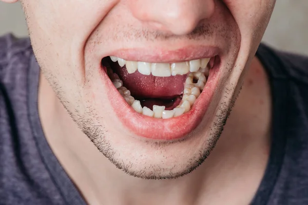 Gran Agujero Diente Mascar Perforado Por Dentista Para Tratamiento — Foto de Stock