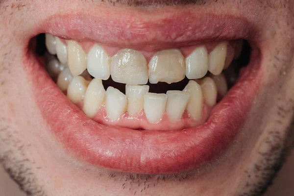 Crooked teeth. Extended tooth with a chip