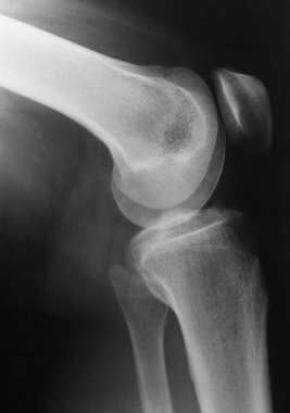 X-ray picture of knee