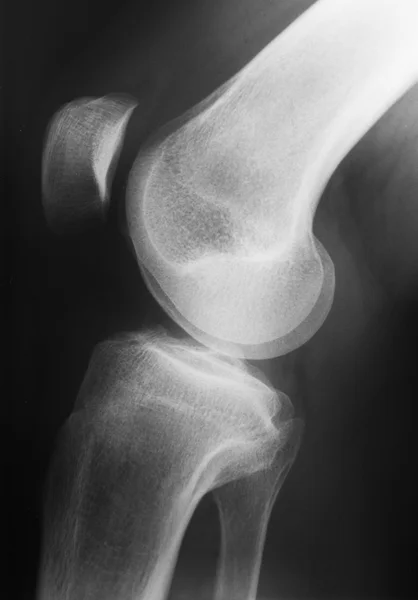 X-ray picture of knee