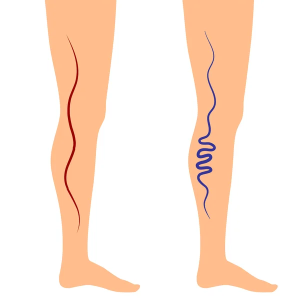 Vettore illustrazione vene delle gambe — Vettoriale Stock