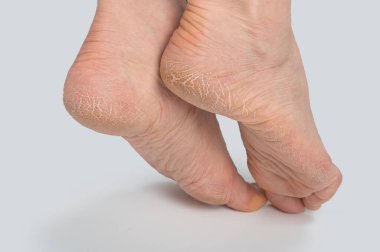 Beyaz arka planda kurumuş ve çatlak ayak tabanları, kuru topuklu kadın ayakları, çatlak deri. Topuktaki çatlakları kötü deriyle kapatın. Sağlık ve Tıp Konsepti.