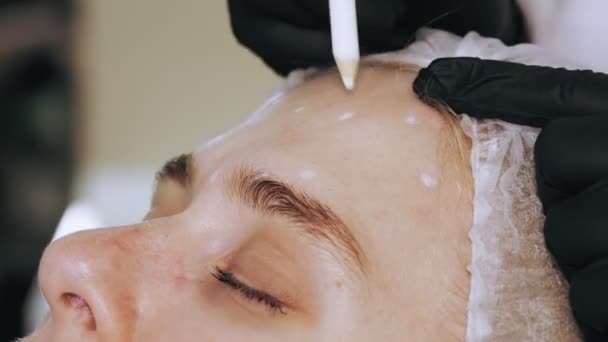 Botox injectie. Schoonheidsinjectie. injecties tegen veroudering. Botulinum therapie. Gezichtsverjonging. De arts maakt markeringen op het voorhoofd van patiënten voor Botox injecties. collageen injecties. Schoonheidsconcept. — Stockvideo