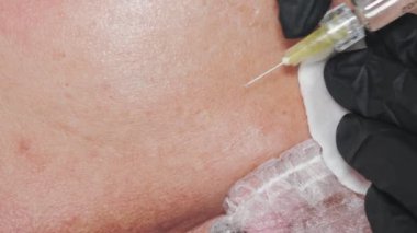 Güzellik iğnesi. Yaşlanma önleyici iğneler. Yüz tazeleme. Doktor güzellik iğneleri yapıyor. Yakın plan. Mezoterapi ve biyo-evitalleşme. Kolajen enjeksiyonları. Güzellik konsepti.