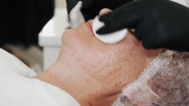 Güzellik iğnesi. Yaşlanma önleyici iğneler. Yüz tazeleme. Doktor, güzellik enjeksiyonlarından sonra hastaları antiseptik pamukla siliyor. Enjekte edilen kan izleri, deride görünen papüller.