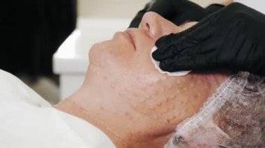 Güzellik iğnesi. Yaşlanma önleyici iğneler. Yüz tazeleme. Doktor, güzellik enjeksiyonlarından sonra hastaları antiseptik pamukla siliyor. Enjekte edilen kan izleri, deride görünen papüller.