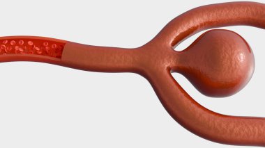 Beyin anevrizmasının 3 boyutlu görüntüsü, beyindeki bir kan damarının yapısal hassasiyetini gösteriyor. Bir kan damarı ya da atardamarı iç akışı göstermek için kesilmiş..