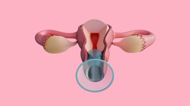 3 boyutlu kadın prezervatifi ya da vajinal kanalın içine yerleştirilmiş iç prezervatif. En alttaki büyük halka cesedin dışında kalıyor. Hamileliği önlemek için fiziksel bir engel..
