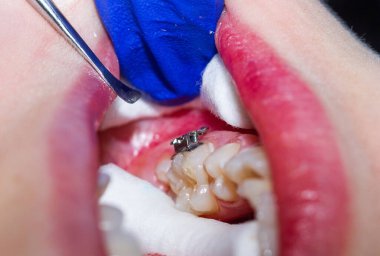 Arka planda bir dişçinin dişini kapat, kapat.