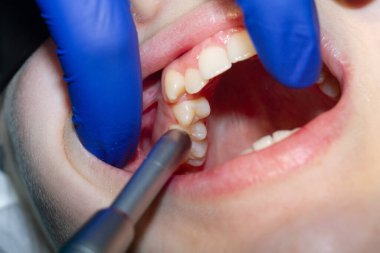 Arka plandaki dişleri kapat, kapat.