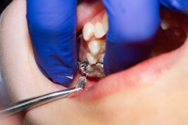 Diş hekiminde diş teli takılı diş teli takmak, diş tellerini takmak ve kemer telini çekmek..