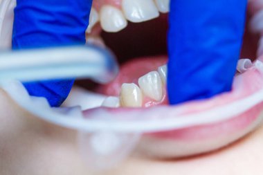Diş tedavisi ve hizalanması, diş tedavisi