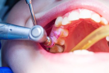 Diş hekiminin ön dişlerinin muayenesi ve tedavisi, dişçi ağzını kemirmiş, yakın çekim, beyaz temiz dişler..