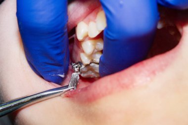 Diş hekiminde diş teli takılı diş teli takmak, diş tellerini takmak ve kemer telini çekmek..