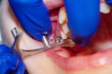 Diş hekiminde diş teli takılı diş teli takmak, diş tellerini takmak ve kemer telini çekmek..