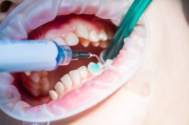 Diş tedavisi ve hizalanması, diş tedavisi