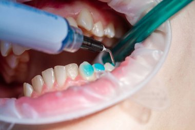 Diş tedavisi ve hizalanması, diş tedavisi