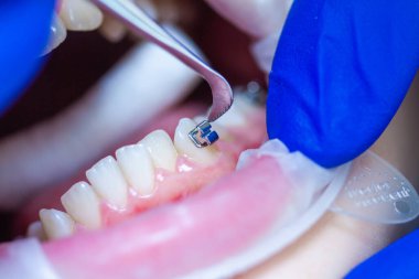 Diş hekiminde diş teli takılı diş teli takmak, diş tellerini takmak ve kemer telini çekmek..