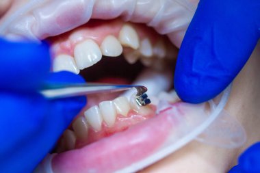 Diş hekiminde diş teli takılı diş teli takmak, diş tellerini takmak ve kemer telini çekmek..