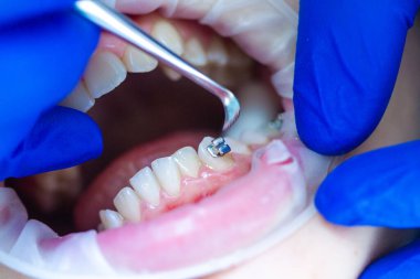 Diş hekiminde diş teli takılı diş teli takmak, diş tellerini takmak ve kemer telini çekmek..