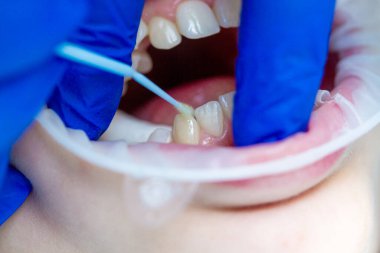Diş tedavisi ve hizalanması, diş tedavisi