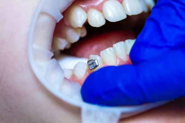 Diş hekiminde diş teli takılı diş teli takmak, diş tellerini takmak ve kemer telini çekmek..