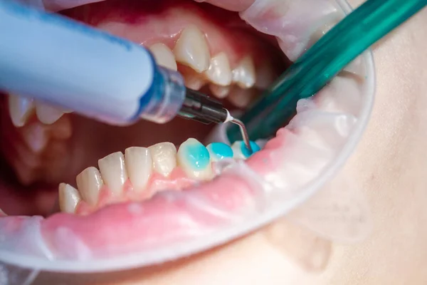 Treatment and alignment of teeth, dental treatment