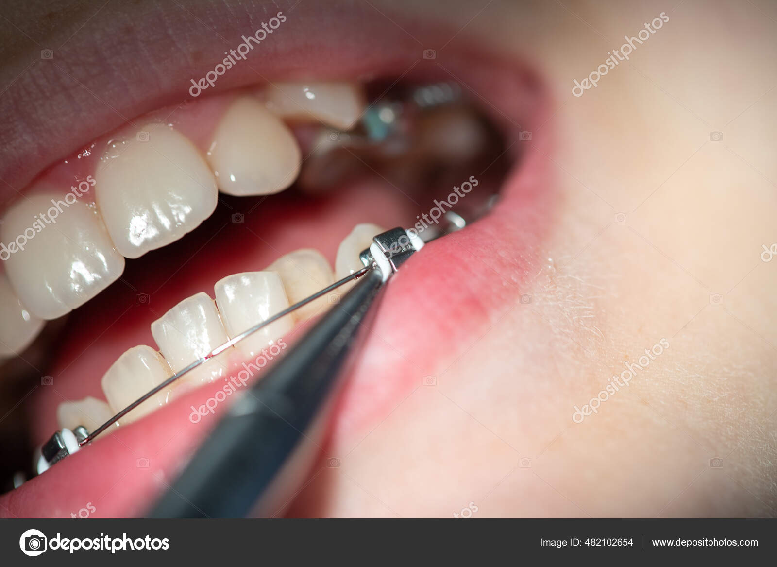 Close Teeth Baby Braces Dentist Appointment Dental Clinic Placing