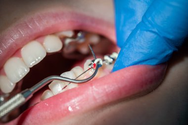 Diş hekiminde diş teli takılmış diş telleri takılmış ve diş telleri takılmış.