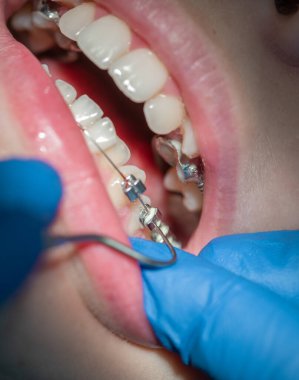 Diş hekiminde diş teli takılmış diş telleri takılmış ve diş telleri takılmış.