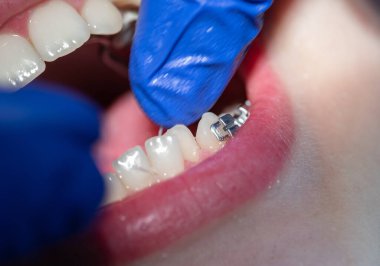 Diş hekiminde diş teli takılmış diş telleri takılmış ve diş telleri takılmış.