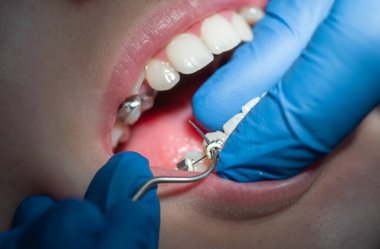 Diş hekiminde diş teli takılmış diş telleri takılmış ve diş telleri takılmış.