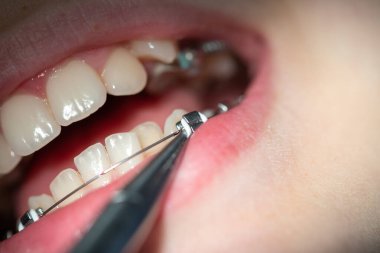 Diş hekiminde diş teli takılmış diş telleri takılmış ve diş telleri takılmış.