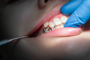 Diş hekiminde diş teli takılmış diş telleri takılmış ve diş telleri takılmış.