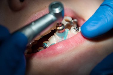 Diş hekiminin ön dişlerinin muayenesi ve tedavisi, dişçi ağzını kemirmiş, yakın çekim, beyaz temiz dişler..