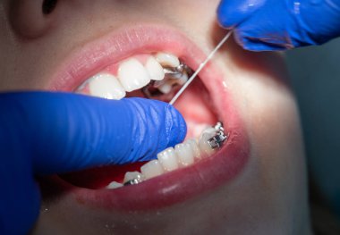 Diş hekiminde diş teli takılmış diş telleri takılmış ve diş telleri takılmış.