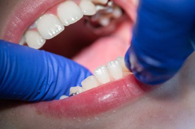 Diş hekiminde diş teli takılmış diş telleri takılmış ve diş telleri takılmış.