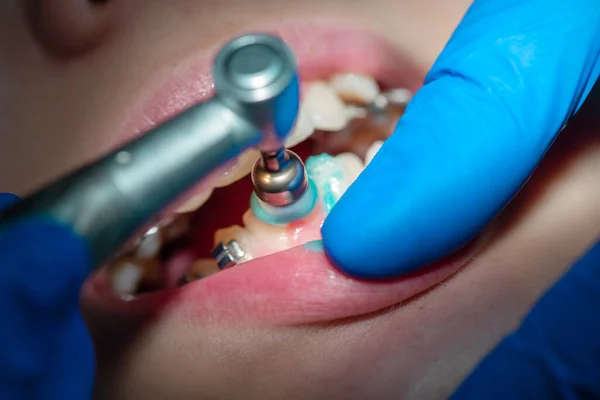 Крупним Планом Зуби Дитячими Брекетами Призначенні Стоматолога Стоматологічній Клініці Розміщенні — стокове фото