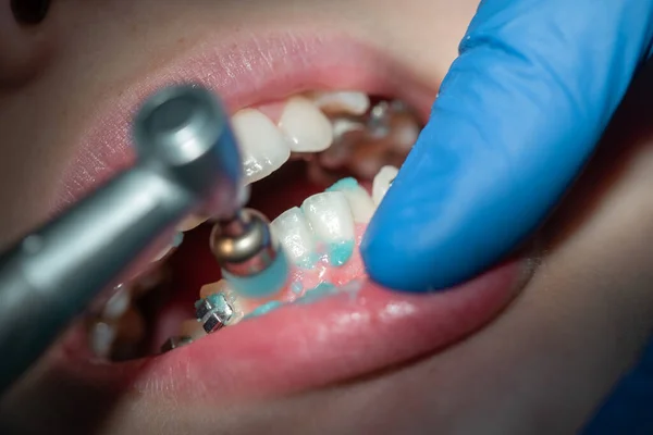 Diş hekiminin ön dişlerinin muayenesi ve tedavisi, dişçi ağzını kemirmiş, yakın çekim, beyaz temiz dişler..