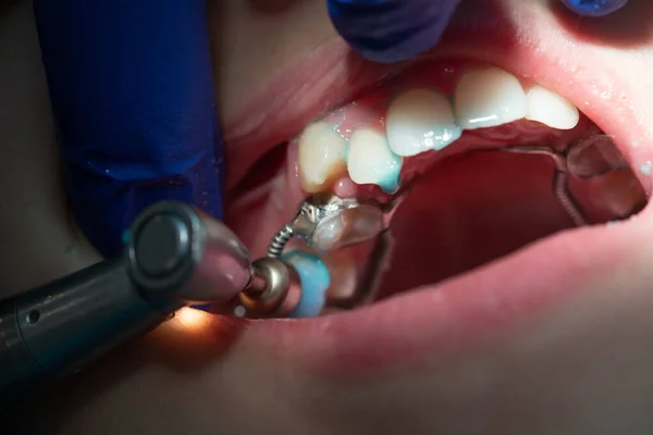 Inspection and treatment of front teeth at the dentist, the dentist gnawed in his mouth, shot closeup, white clean teeth.