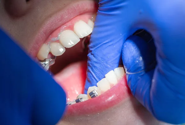 Крупним Планом Зуби Дитячими Брекетами Призначенні Стоматолога Стоматологічній Клініці Розміщенні — стокове фото