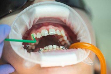 Bir doktor diş sağlığı kliniğinde özel aletler kullanarak diş tellerini ayarlarken bir hasta ortodonti tedavisi görüyor. Çevre temiz ve profesyonel..