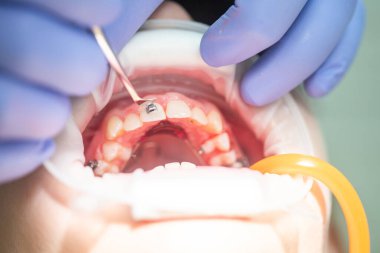 Bir ortodontist, modern bir diş ortamında düzgün bir hizalama ve konfor sağlarken diş tellerine ayarlamalar yaparak hastanın dişleri üzerinde dikkatle çalışır..