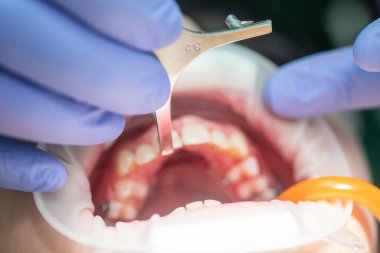 Sakin bir diş kliniğinde, yetenekli bir ortodontist diş hizasını ayarlamak için özel aletler kullanır. Hasta rahat bir şekilde oturup, daha pürüzsüz bir diş deneyimi sağlıyor..